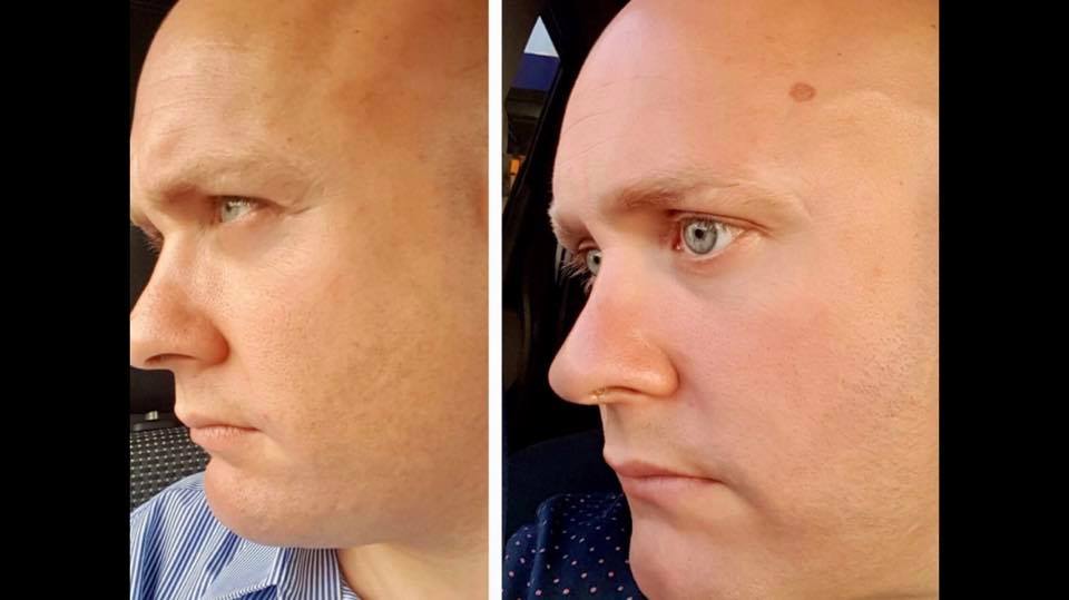Pigmentation before and after cryotherapy — DK Aesthetics